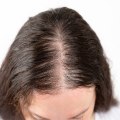 Understanding and Treating Female Hair Loss