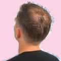 Diagnosing Male Pattern Baldness: Understanding the Causes, Treatments, and Prevention