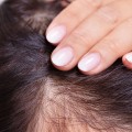 Avoiding Heat Damage to Hair: Tips and Techniques for Preventing Baldness and Promoting Regrowth