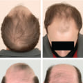 Understanding Hair Fibers: Prevention, Treatment, and Solutions for Hair Loss