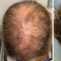 Natural Remedies for Male Pattern Baldness: Prevent, Slow Down, and Regrow Hair