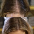 Scalp Camouflage Techniques: A Comprehensive Look at Hair Loss Solutions and Treatments