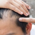 A Comprehensive Guide to Medical Treatments for Male Pattern Baldness