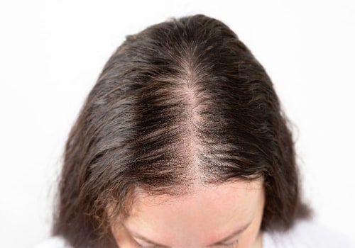 Understanding and Treating Female Hair Loss
