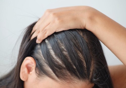 Exploring the Connection Between Lifestyle Factors and Female Hair Loss