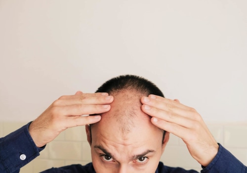 Lifestyle Factors and Male Pattern Baldness: Understanding the Causes and Finding Solutions