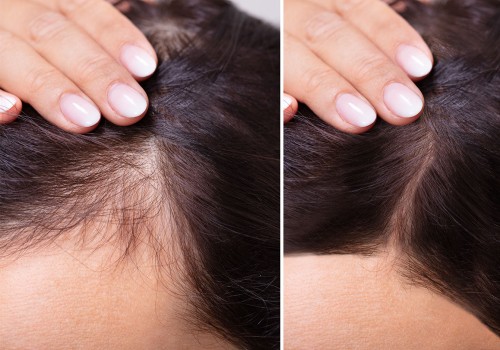 Avoiding Heat Damage to Hair: Tips and Techniques for Preventing Baldness and Promoting Regrowth