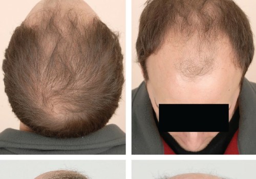 Understanding Hair Fibers: Prevention, Treatment, and Solutions for Hair Loss