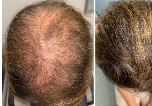 Natural Remedies for Male Pattern Baldness: Prevent, Slow Down, and Regrow Hair