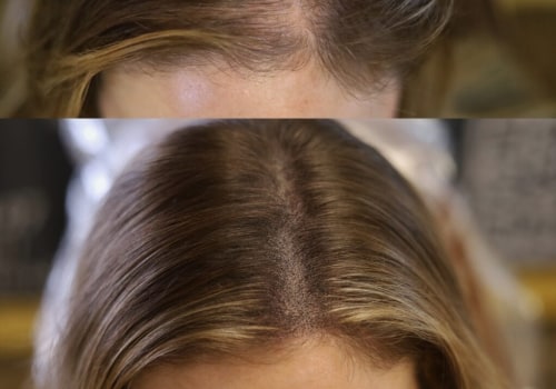 Scalp Camouflage Techniques: A Comprehensive Look at Hair Loss Solutions and Treatments