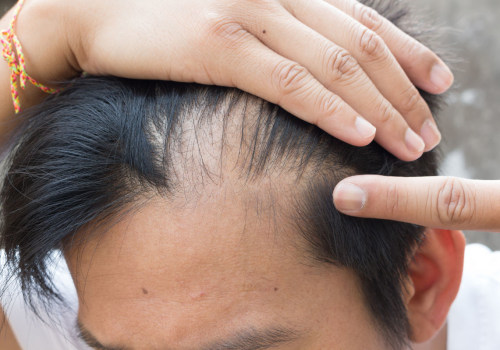 A Comprehensive Guide to Medical Treatments for Male Pattern Baldness